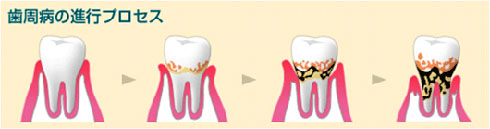 歯周病の進行プロセス