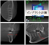 インプラント計画