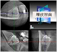 埋伏智歯