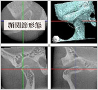 顎関節形態