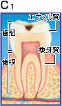 虫歯治療について