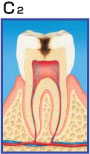 虫歯治療について