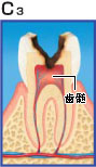 虫歯治療について