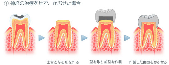 クラウン：ある程度進行した虫歯の時に全体を覆うもの。