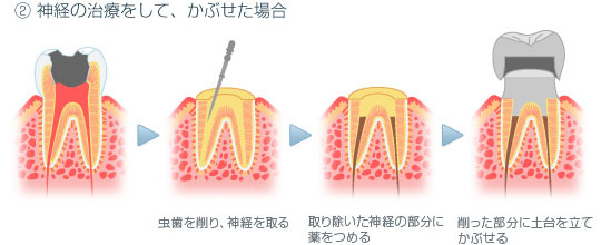 クラウン：ある程度進行した虫歯の時に全体を覆うもの。